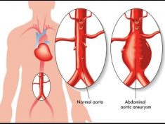 An Aneurysm (AN-u-rism) is a balloon-like bulge in the wall of an artery or the heart muscle. Th ...
