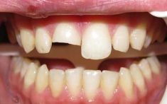 How Much Does a Tooth Filling Cost | Fix Chipped & Broken Tooth Filling