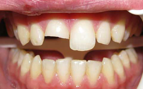 How Much Does a Tooth Filling Cost | Fix Chipped & Broken Tooth Filling