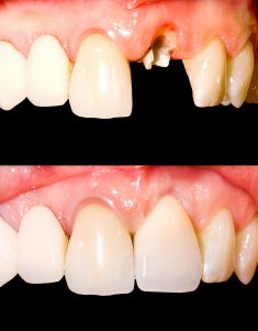 Benefits of Dental Crown Procedure | Dental Crown Near Me
