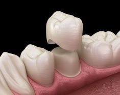 Benefits of Dental Crown Procedure | Dental Crown Near Me