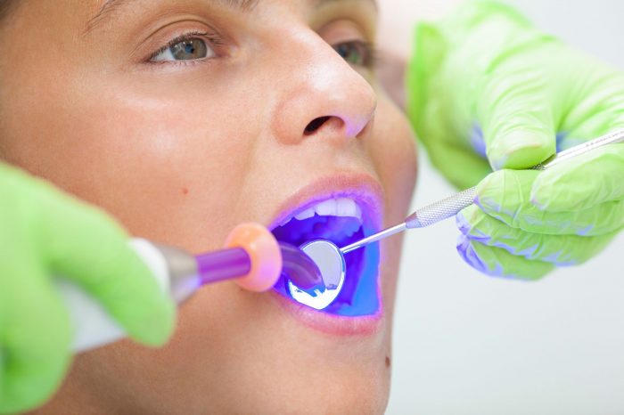 What Are The Benefits Of Getting A Dental Filling?