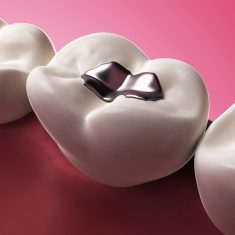 What’s The Reason For Temporary Filling On Tooth And Not Permanent?