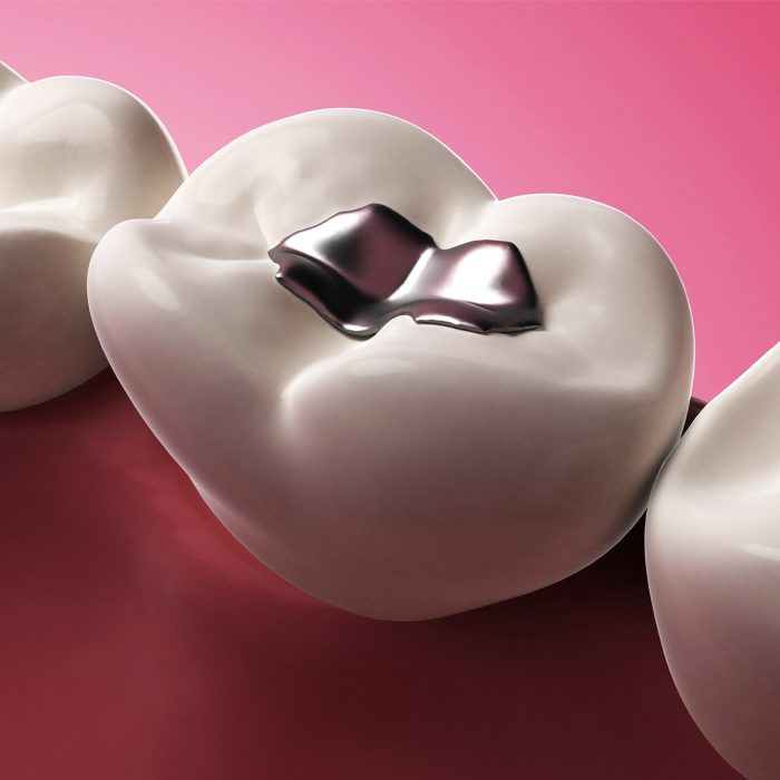 What’s The Reason For Temporary Filling On Tooth And Not Permanent?