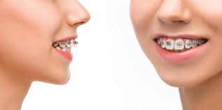 Affordable Dental Braces Near Me