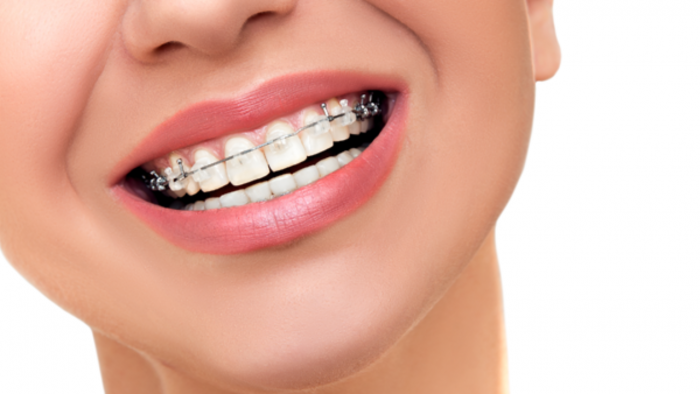 Type of Braces : Traditional Metal Braces, Ceramic Braces, Silver Braces