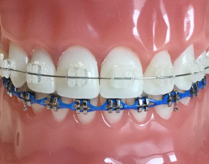Type of Braces : Traditional Metal Braces, Ceramic Braces, Silver Braces
