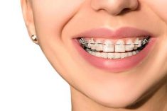 Lingual Braces in Miami, FL