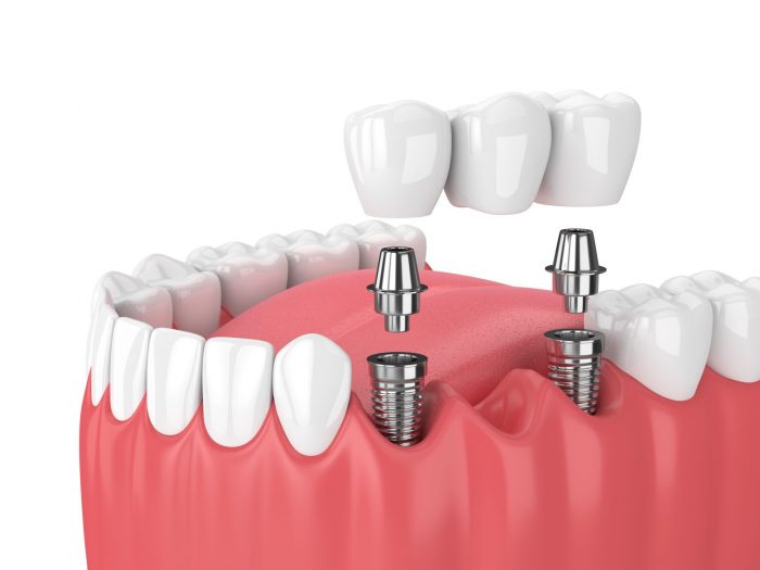 Affordable Dentures Near Me | Implant Supported Dentures in Houston TX