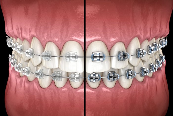 Type of Braces : Traditional Metal Braces, Ceramic Braces, Silver Braces