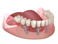 Best Dental Implants in Houston, TX