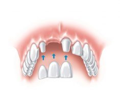 Best Dental Implants in Houston, TX