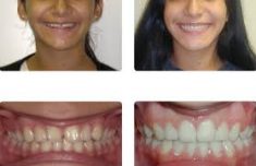 Adult braces before and after