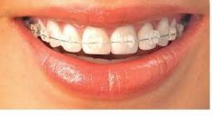 Adult braces before and after