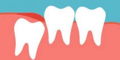 Wisdom Tooth Removal Houston TX | Emergency Wisdom Teeth Removal Near Me