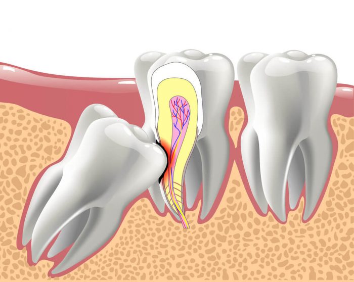 Wisdom Tooth Extraction Near Me in Houston