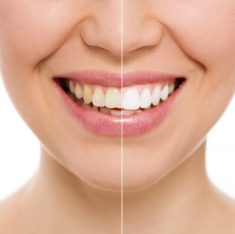 Zoom Teeth Whitening Services Near Me