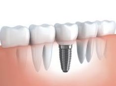 Best Dental Implants in Houston, TX