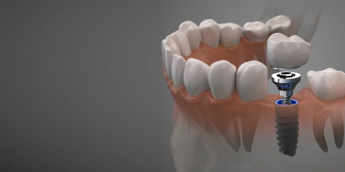 Same Day Dental Implants in Houston TX