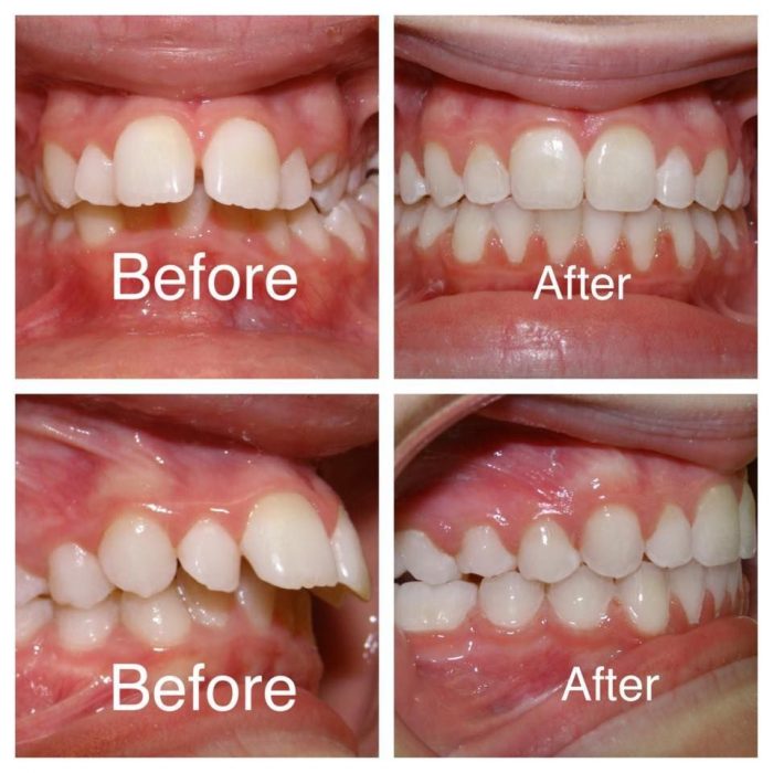 Adult braces before and after