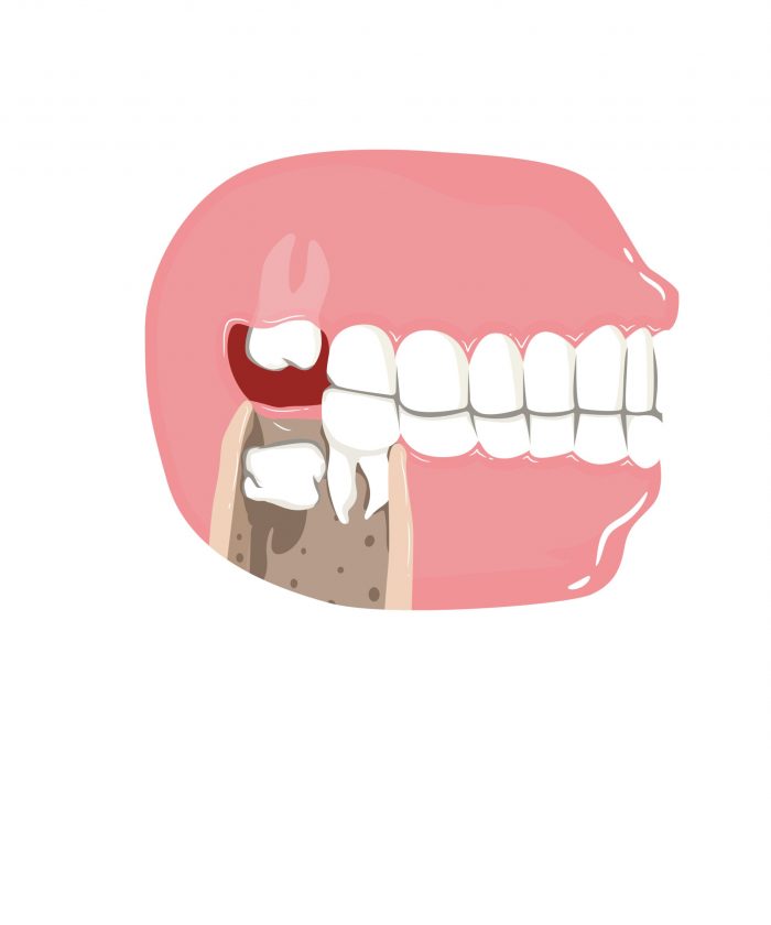 Wisdom Tooth Extraction Near Me in Houston