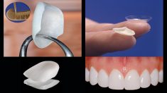 Porcelain Veneers Before and After | Porcelain Veneer or Dental Veneers