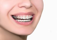Find The Best Braces Dentist Near Me | Ivanov Orthodontic