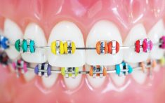 Best Braces Color Ideas | Ivanov Orthodontic
