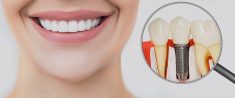 Affordable Teeth Implants in Houston TX