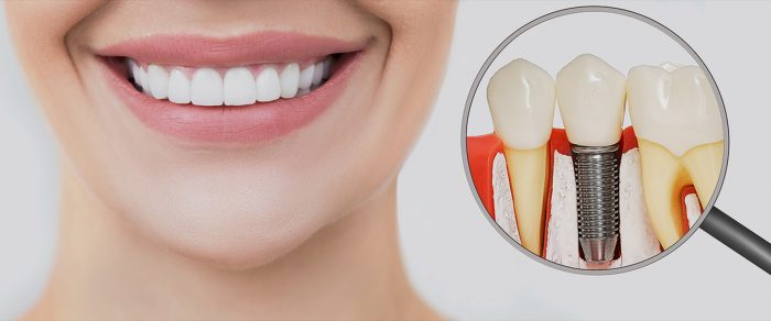 Affordable Teeth Implants in Houston TX