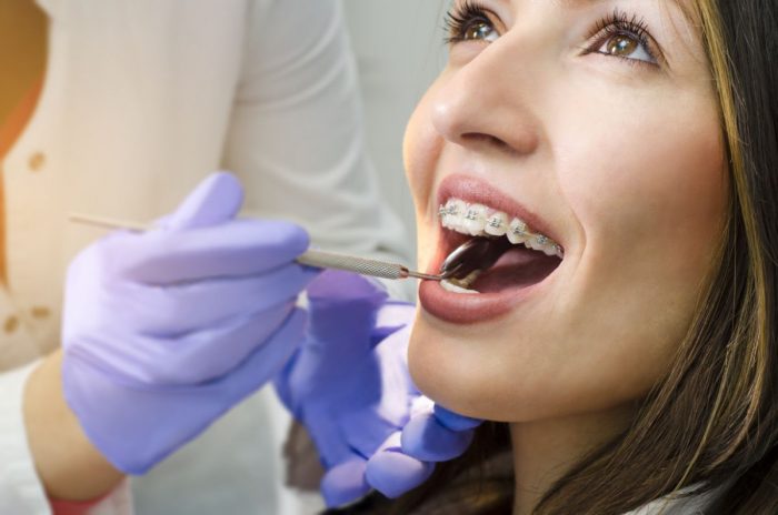Adult Orthodontics in Miami, FL