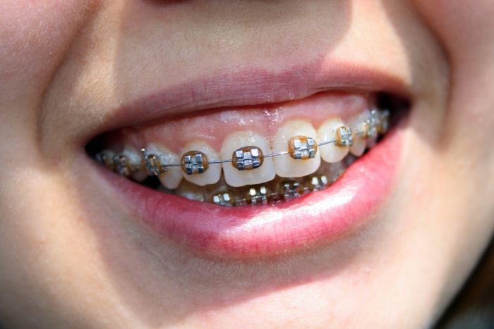 Can Braces Fix An Overbite?
