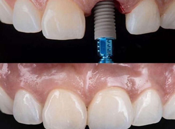 Best Dental Implant Dentist Near Me
