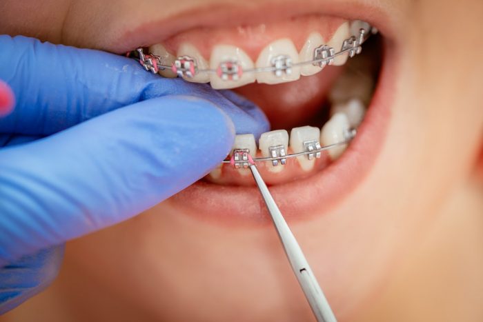 Should You Get Braces Before Implants