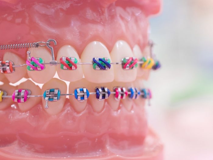 How to Choose the Best Braces Colors?