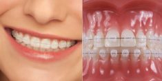Different Color Braces For Teeth