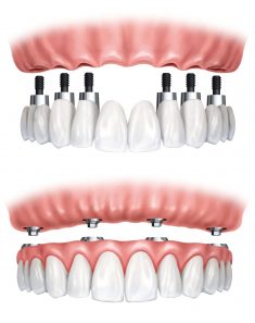 Full Mouth Dental Implants Procedure