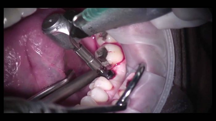 Tooth Implant Procedure: How Is It Done?