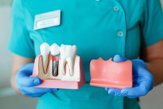 Best Dental Implant Dentist in Houston TX