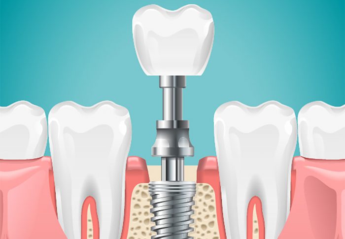 Dental Implant Surgeons Near Me