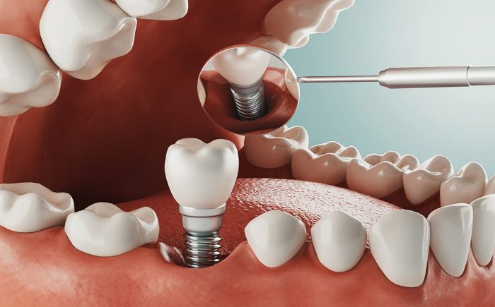 Dental Implant Surgery in Houston TX
