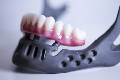 Tooth Implant Surgery in Houston TX