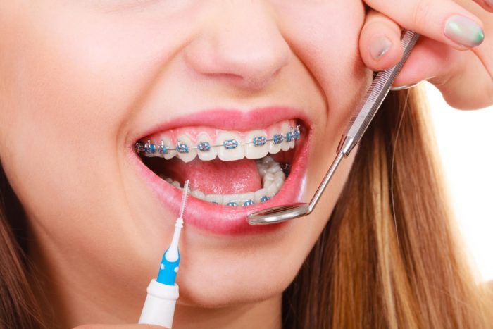 Invisible Orthodontic Braces In Miami Fl