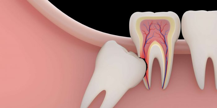 Wisdom Tooth Removal Houston
