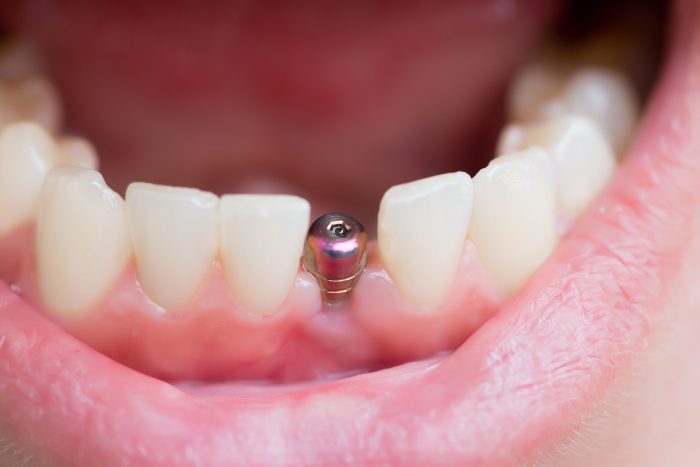 Dentures And Implants Solutions