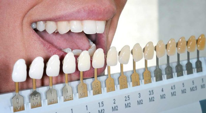 teeth whitening services in Houston