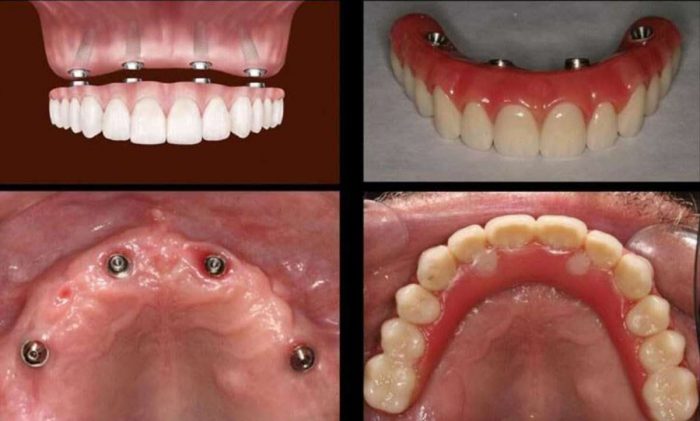 Dental Implants in Midtown Houston TX
