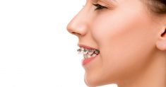 Can Braces Fix An Overbite?