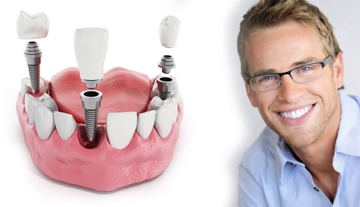 Multiple Teeth Dental Implants Houston TX