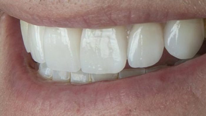 Need Braces To Straighten Teeth Before Veneers
